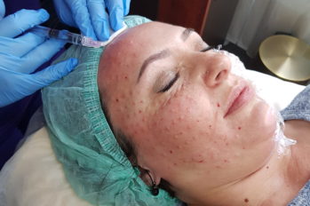 плазмолифтинг