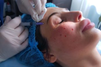 плазмолитфинг