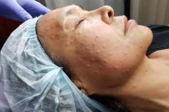 плазмолифтинг