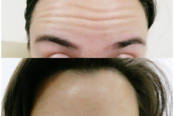 ботокс алматы