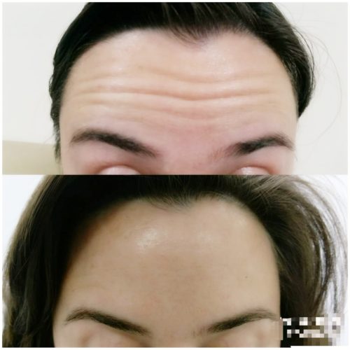 ботокс алматы