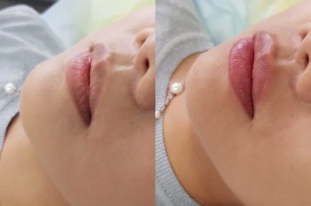 увеличение губ