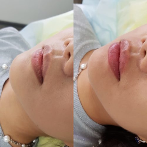 увеличение губ