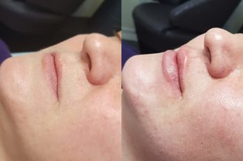 увеличение губ