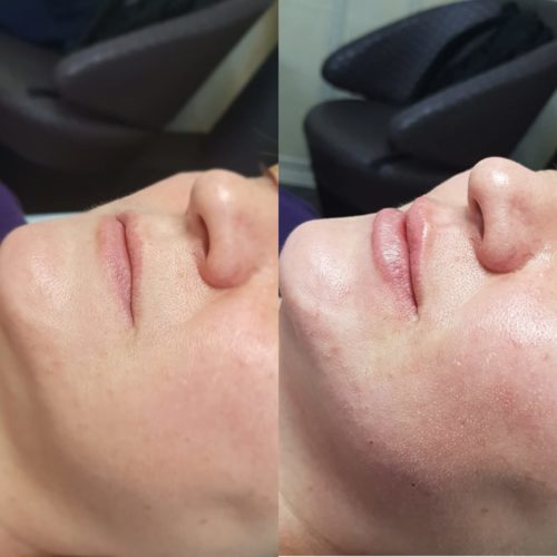 увеличение губ