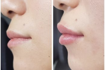 увеличение губ