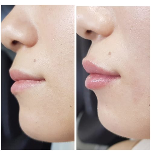 увеличение губ