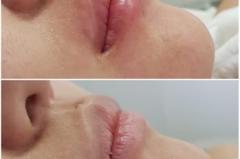 увеличение губ