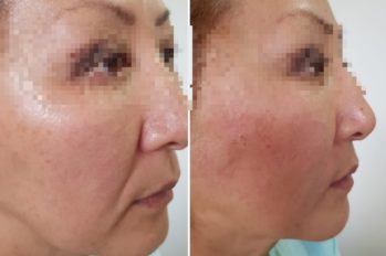 инъекции золушка