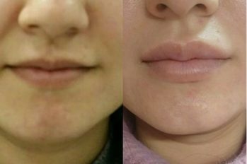 увеличение губ