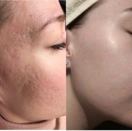 лазерная шлифовка