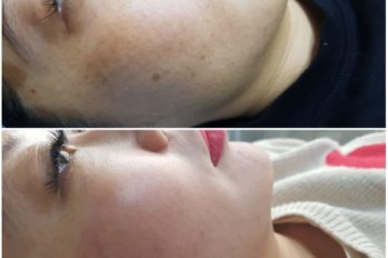 лазерная шлифовка