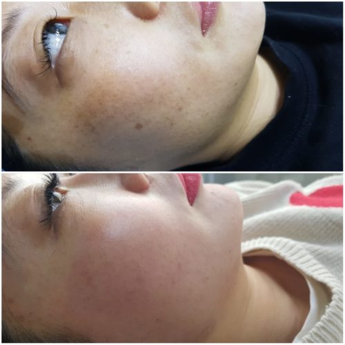 лазерная шлифовка