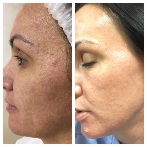 лазерная шлифовка