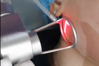 лазерная шлифовка